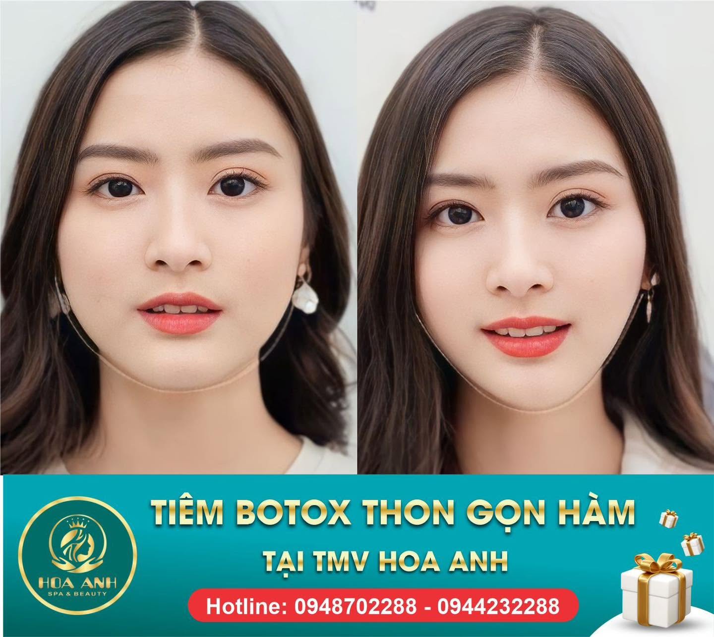 Trước và sau tiêm Botox thon gọn hàm tại Hoa Anh — ca 2